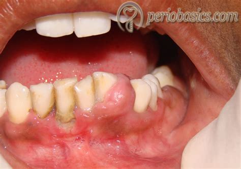 Gingival Enlargement Clinical Periodontology