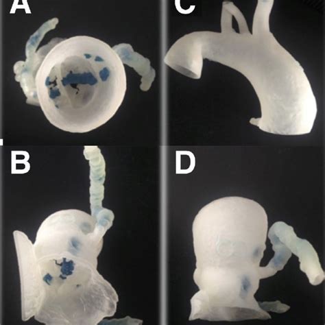 Three Dimensional Printed Models For Preoperative Planning Download Scientific Diagram