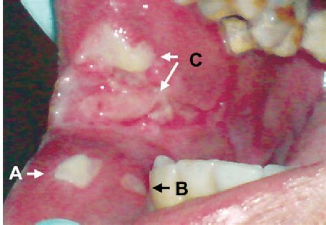 Visit Multiple Ulcers And Scars On Lower Labial Mucosa And Right