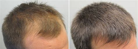 Миноксидил для мужчин ᐈ Купить Minoxidil для мужчин в Киеве и Украине ...