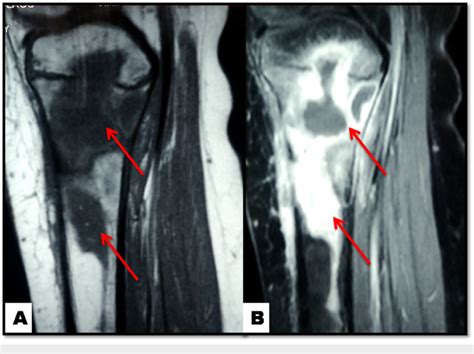 Knee MRI Osteomyelitis Of The Proximal Tibia Red Arrows A Sagittal