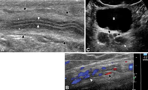 Pathologic Conditions At Imaging Of The Spermatic Cord Radiographics