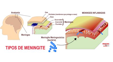 Tipos De Meningite Infecciosa Medicina Mitos E Verdades