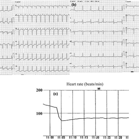 Electrocardiogram Showing Paroxysmal Supraventricular Tachycardia With Download Scientific