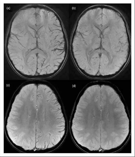 Figure 2 From The Diagnostic Role For Susceptibility Weighted Mri