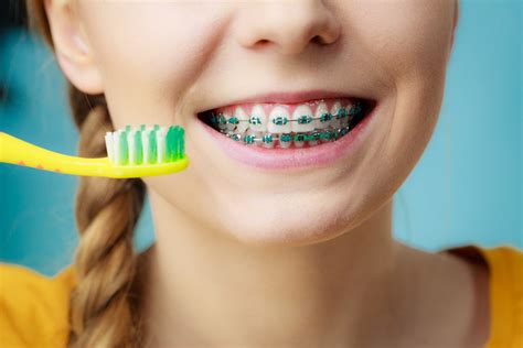 4 Tips To Help You Prevent Tooth Decay While Wearing Braces