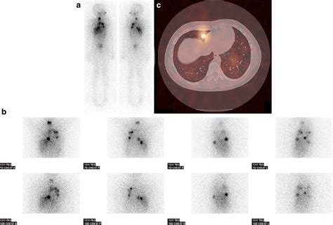 Pulmonary Activity A Anterior And Posterior Whole Body Scan Days