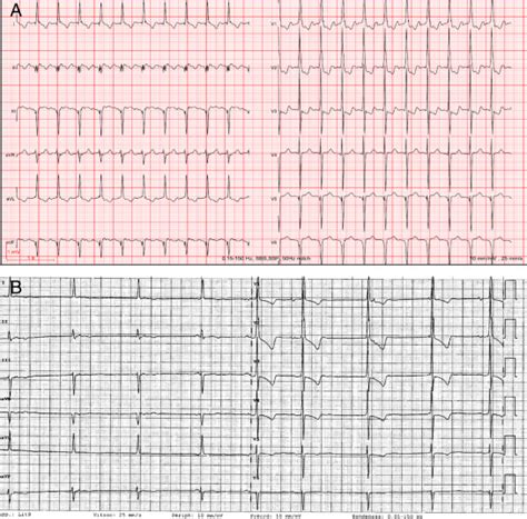 Electrocardiogram Recordings A Atrial Flutter Characterized By