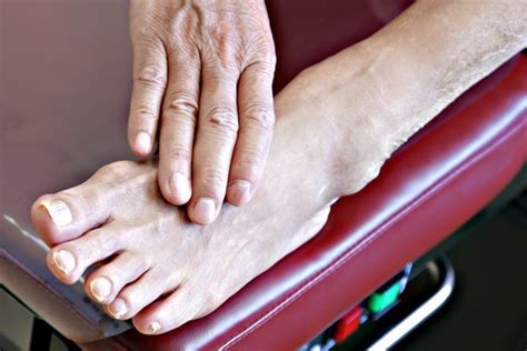 Foot Problems Arthritis Treatment Island Foot Clinics