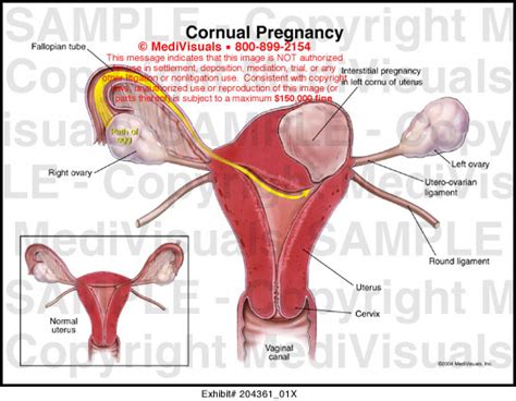 Cornual Pregnancy Medical Illustration Medivisuals