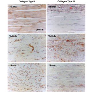 Immunohistochemical Staining Of Type I And Type III Collagen After