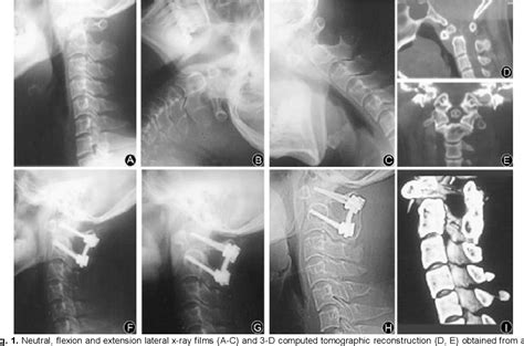 Figure 1 From Posterior Fixation And Fusion With Atlas Pedicle Screw