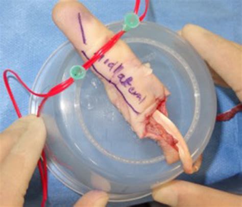 An Efficient Method Of Soft Tissue Preparation Of Amputated Digits For