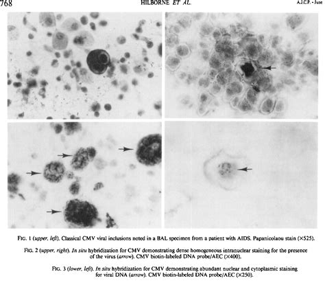 Figure 2 From Direct In Situ Hybridization For Rapid Detection Of Cytomegalovirus In