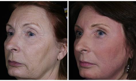 Cold Plasma Non-Surgical Facelift? | Med Spa | Louisville | CO