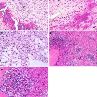 Calcifying Aponeurotic Fibroma CAF Ac And Giant Cell Tumor Of Soft