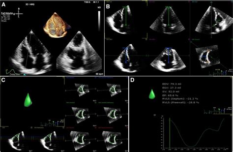 Frontiers Decreased Ventricular Systolic Function In Chemotherapy