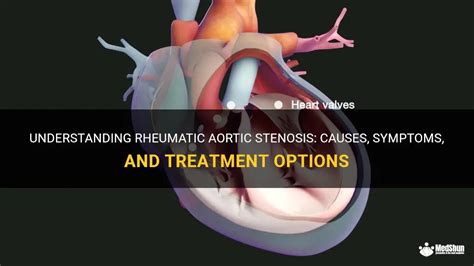 Understanding Rheumatic Aortic Stenosis Causes Symptoms And