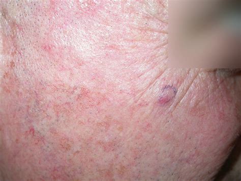 Acd A Z Of Skin Merkel Cell Carcinoma