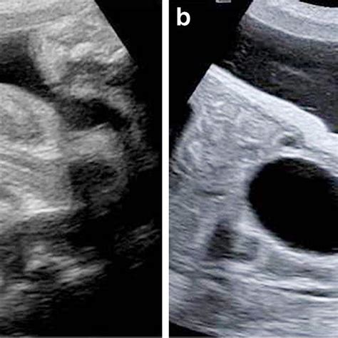 Hypospadias In A Fetus At Weeks Of Gestation A Axial Us View