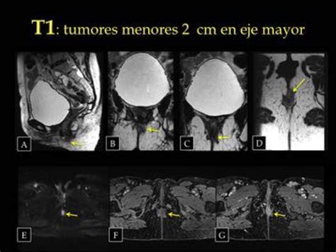 Figure from VALORACIÓN DEL CARCINOMA DEL CANAL ANAL POR RESONANCIA MAGNÉTICA Semantic Scholar