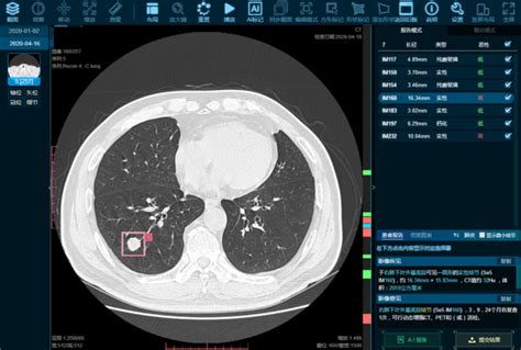 医生直观快速诊疗 快速应对，ai助力静安区中心医院肺癌早筛全面发力 医准智能