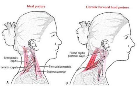 Text Neck Physiopedia