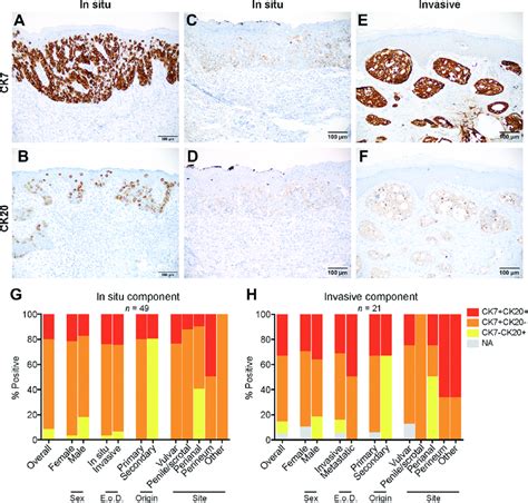 Expression And Coexpression Of Ck7 And Ck20 In Empd A A Ck7