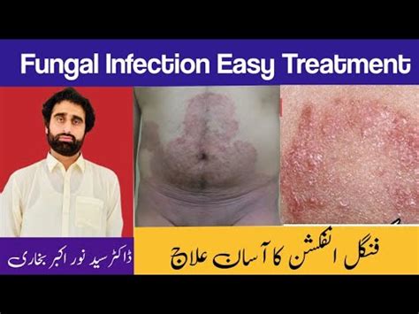 RINGWORM TREATMENT FUNGUS KA Ilaj Daad Ko Jad Se Kaise Khatam Kare