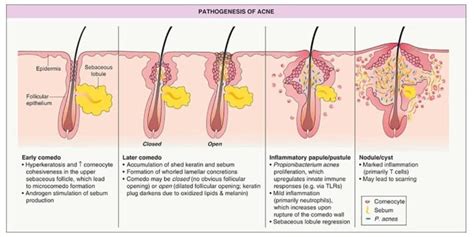 Challenge Of Comedonal Acne Treatment Grounded In 4 Essential Principles Transcend The Conventions