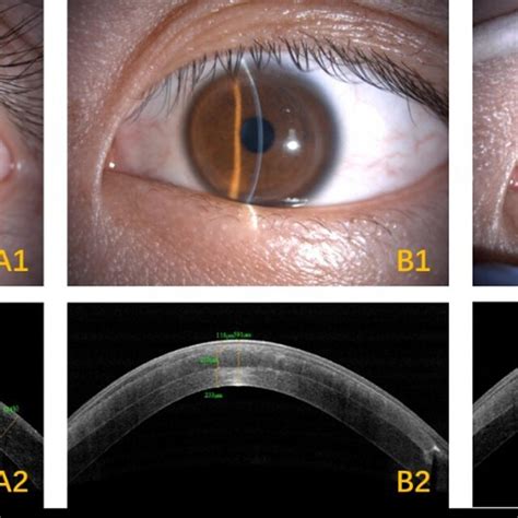 Slit Lamp Microscopic Images And As Oct Of One Treated Eye A1c1 Slit