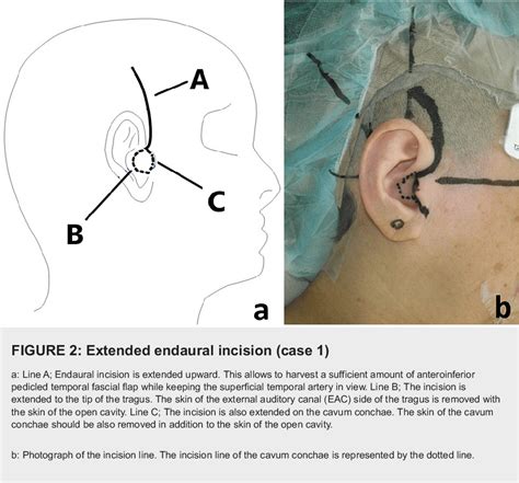 Figure 1 From Our Experience Of 4 Cases Of Extended Endaural Incision