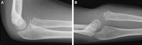 Plain X-ray of right elbow joint (lateral view). (A) Elbow flexed... | Download Scientific Diagram