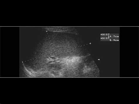 Wk 5 Spleen Pathology Pediatrics Splenomegaly Pediatrics Sonography