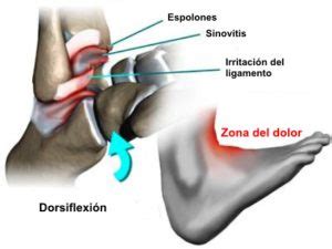 S Ndrome Del Pinzamiento Anterior De Tobillo Cl Nica De Lesiones