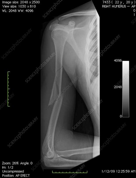 X Rays Of Broken Arm