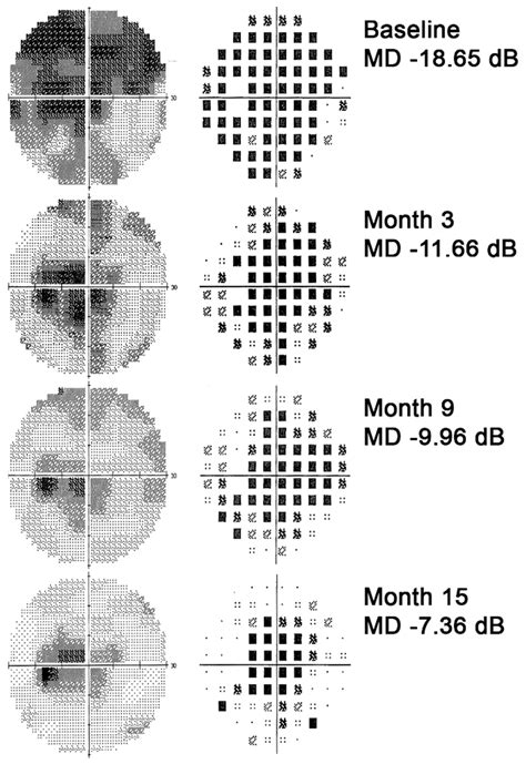 Jcm Free Full Text Changes In Visual Function And Correlations With