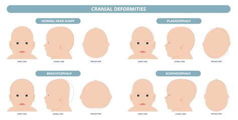 Let's talk head shape — Physio Wagga | Exercise Physiology Wagga ... 