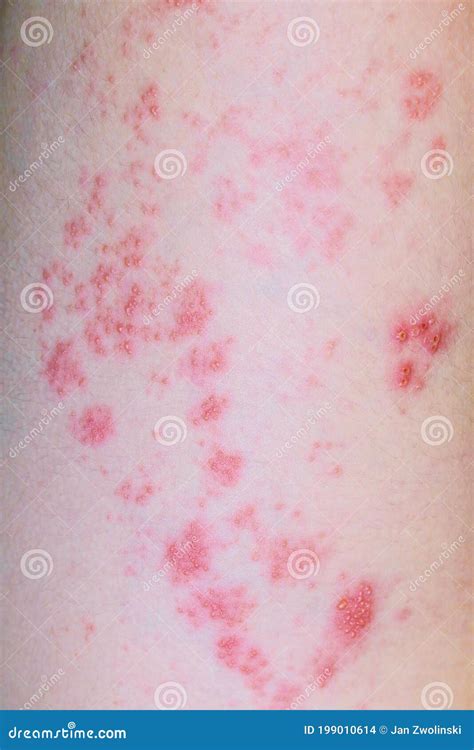 Herpes On Leg