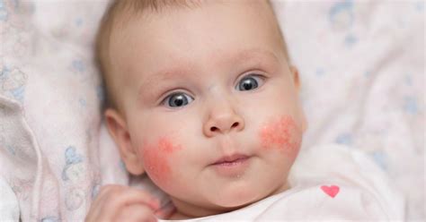 Eczema In Babies And Children - Netmums