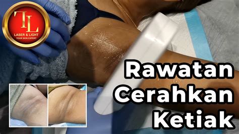 Rawatan Cerahkan Ketiak Laser Light Skin Centre YouTube