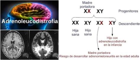 Adrenoleucodistrofia Qué Es Factores De Riesgo Tipos Causas