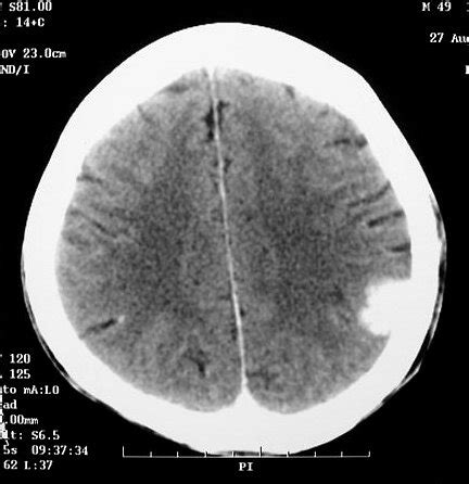 Meningioma O que é sintomas e tratamento Dr Marcelo Acosta