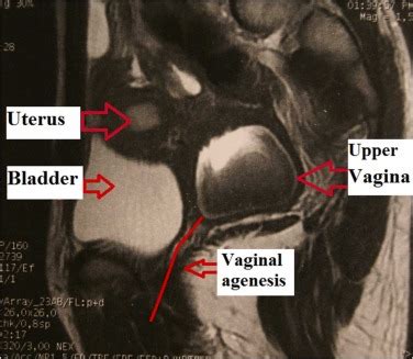 The Use Of Urogenital Mobilization Extended By Two Flaps From The