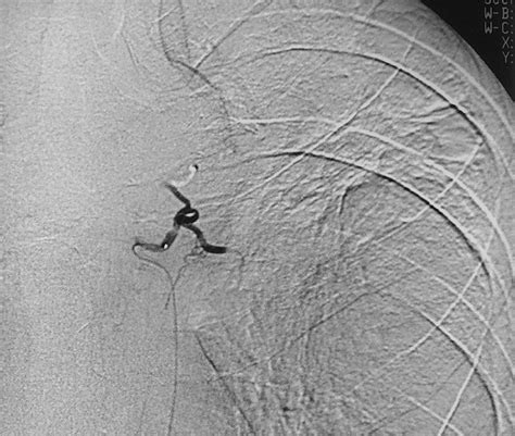 Bronchial And Nonbronchial Systemic Artery Embolization For Life