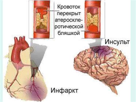 Лекарственные препараты для лечения ИБС - online presentation