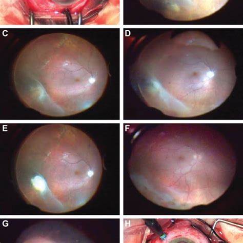 Patient #10, 52 year old, female, right eye: scleral buckling procedure ...