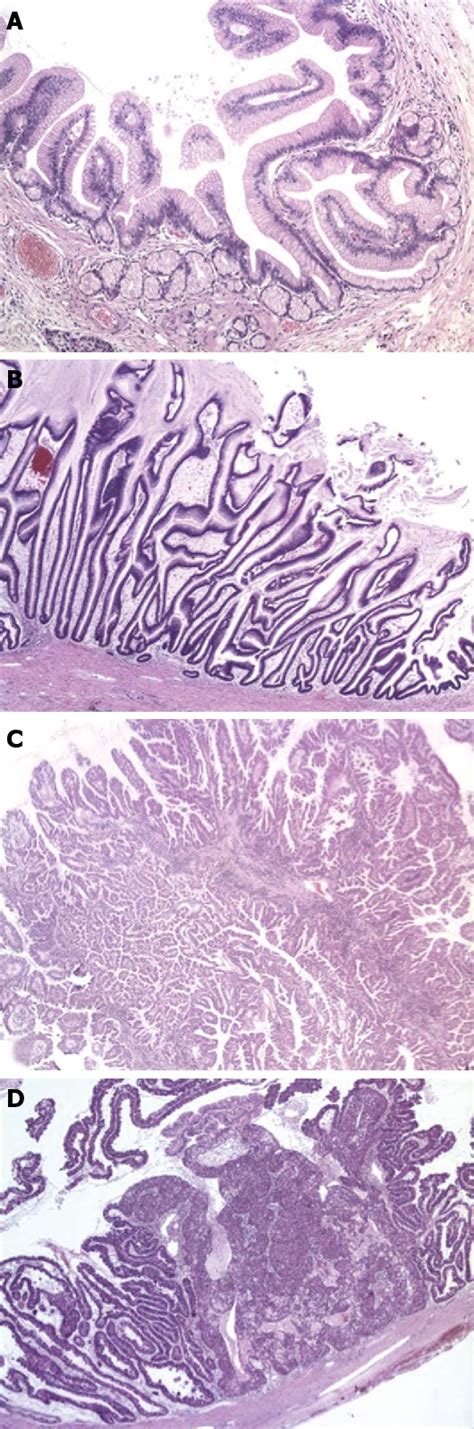 Figure 2 From Intraductal Papillary Mucinous Neoplasia Of The Pancreas