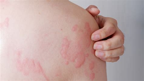 How To Get Rid Of Hives