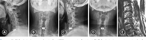 Figure 2 From Application Of Posterior Endoscopic Cervical Foraminotomy